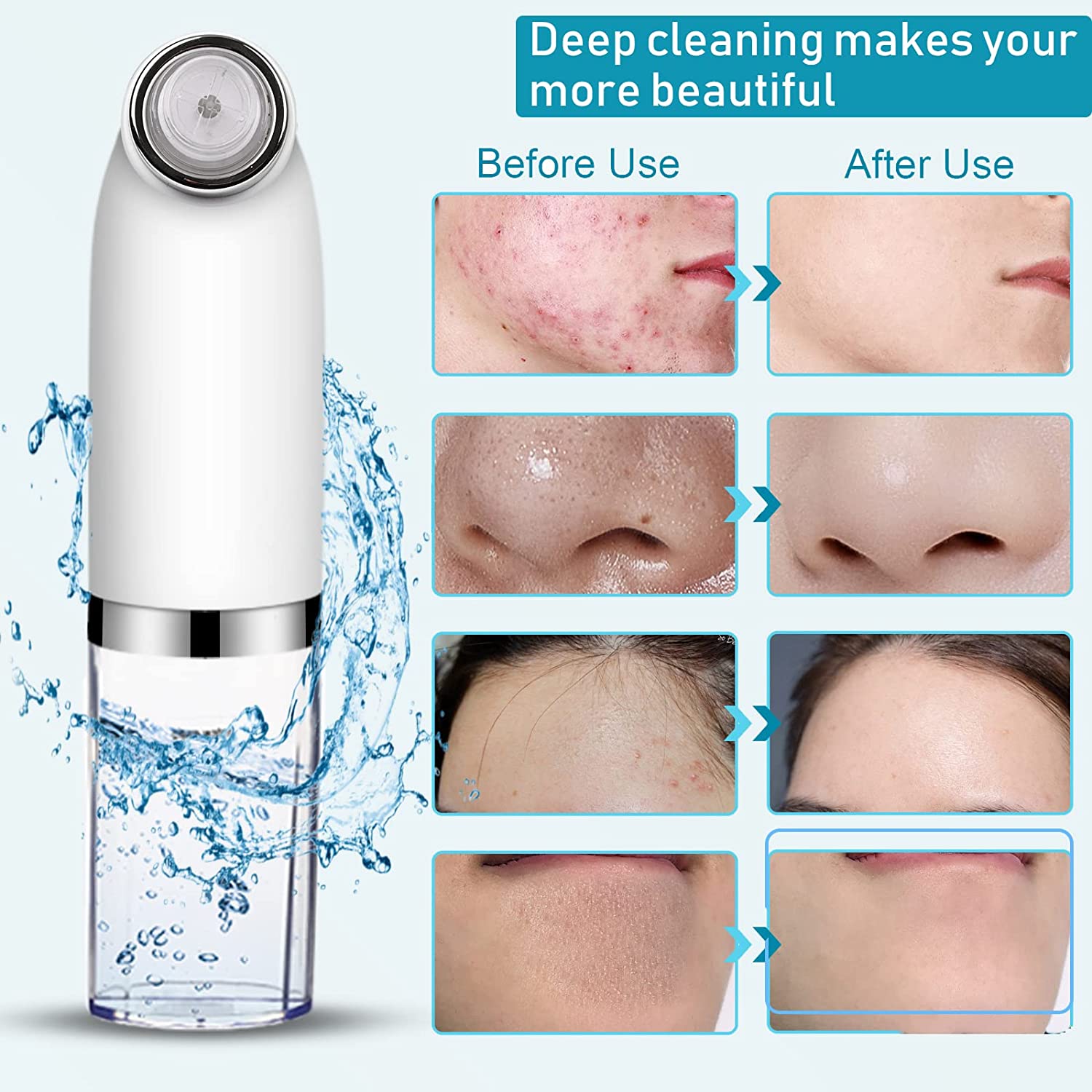 Electric Acne Tool Set USB Charging Blackhead Remover Pore