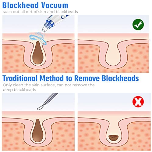 Blackhead Remover Pore Vacuum Upgraded Facial Cleaner Electric Acne Comedone Whitehead Extractor Tool-5 Suction Power 5 Probes Kit