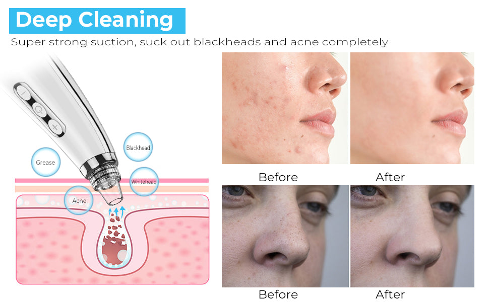 Blackhead Remover Pore Vacuum Upgraded Facial Cleaner Electric Acne Comedone Whitehead Extractor Tool-5 Suction Power 5 Probes Kit